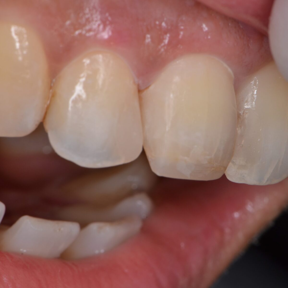 前歯のつめもの２