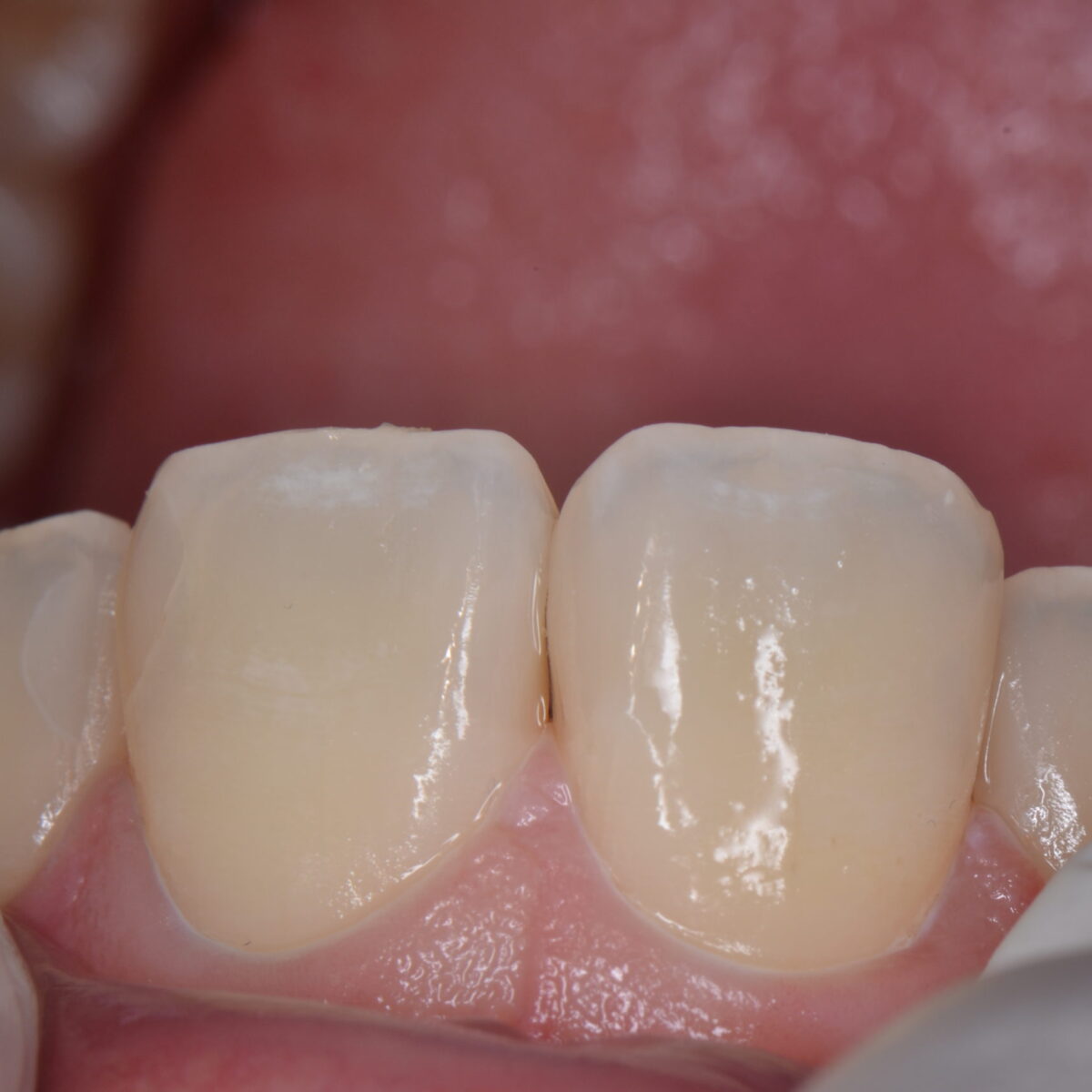 前歯のつめもの