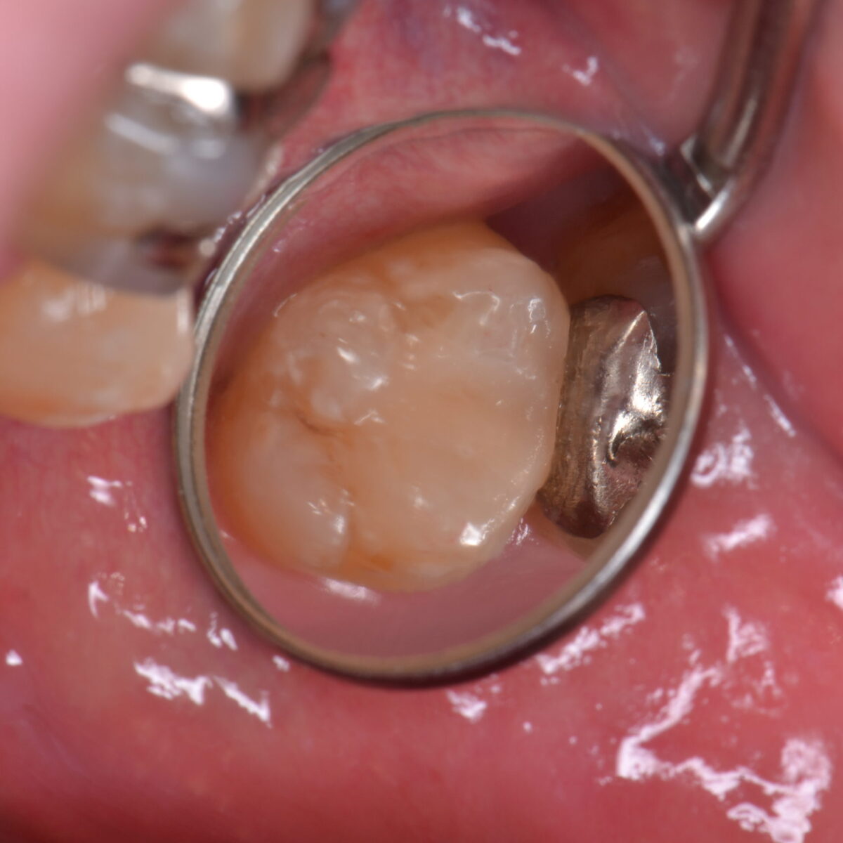 奥歯の白いつめもの