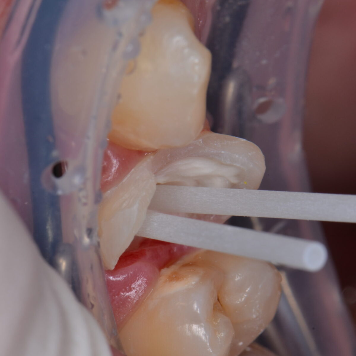 神経をとった歯の処置