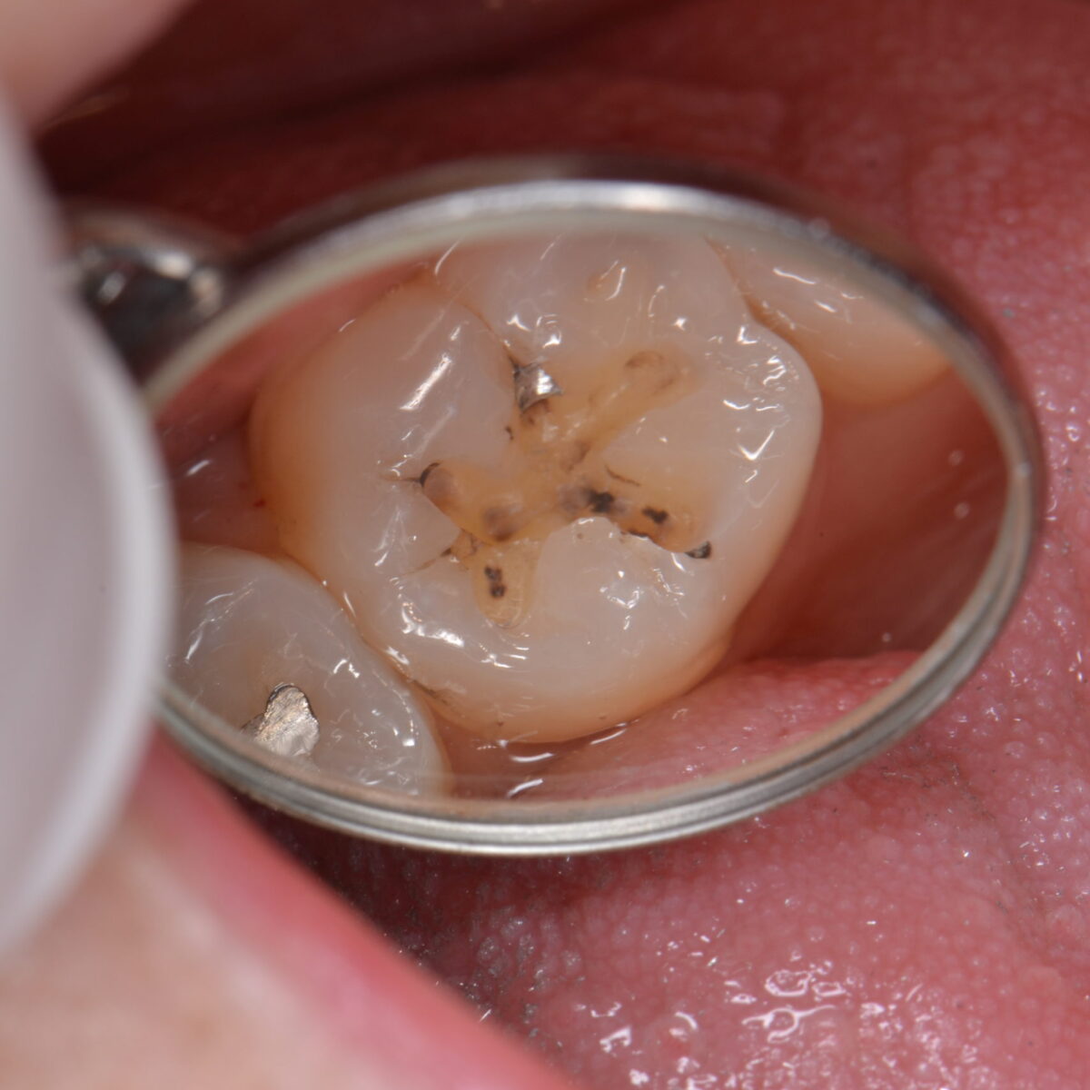 当院が銀歯を推奨しないワケ2