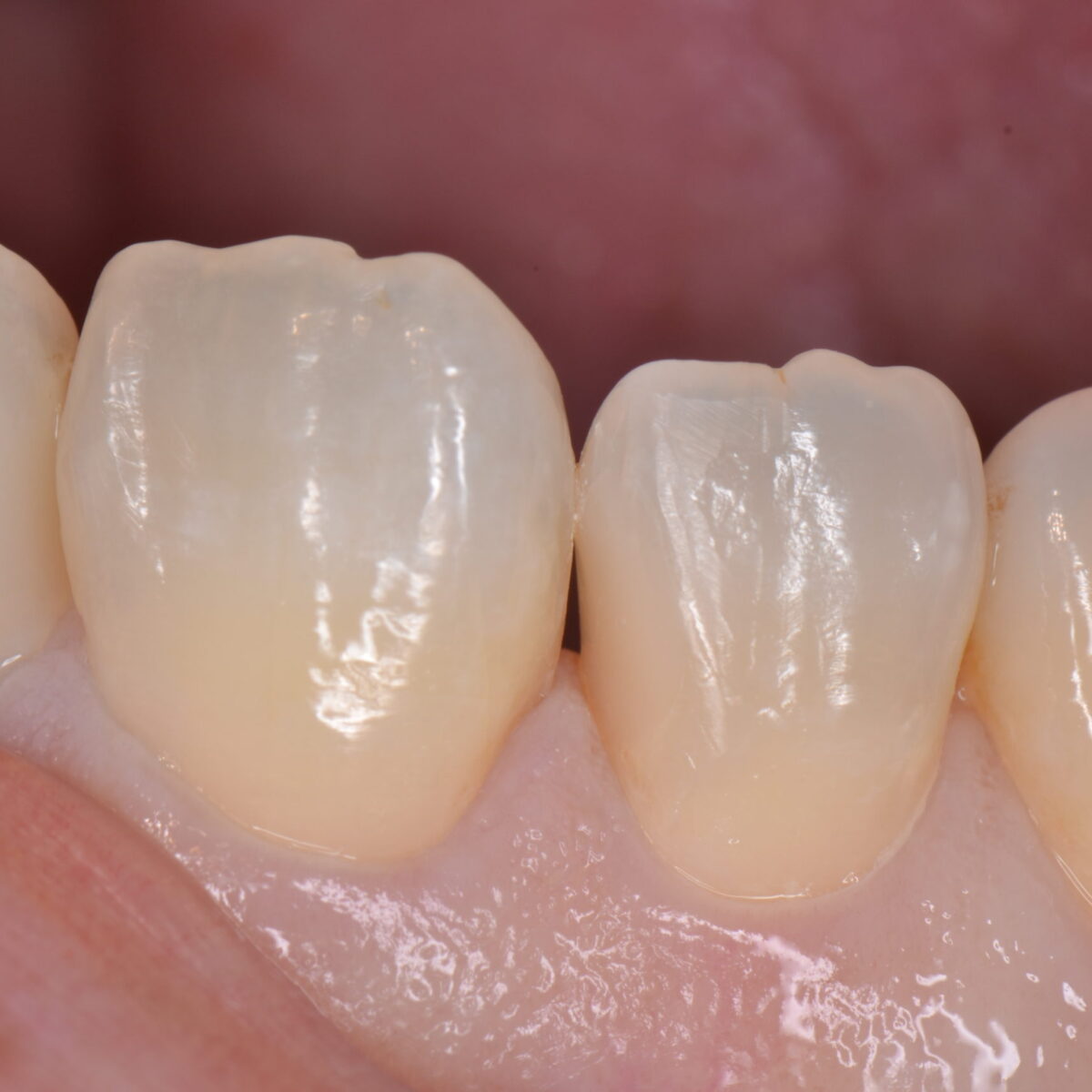 前歯のつめもの３