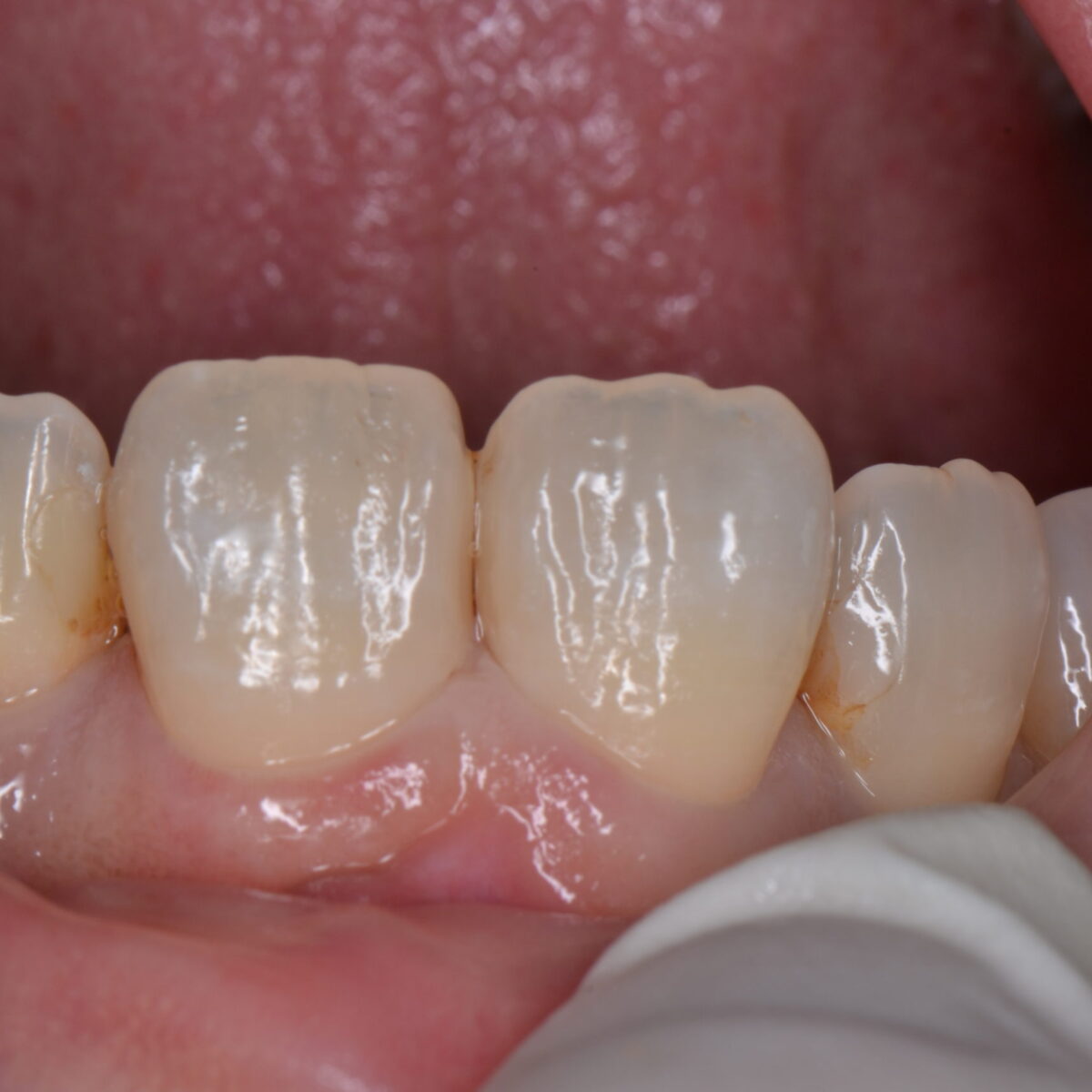 前歯のつめもの４