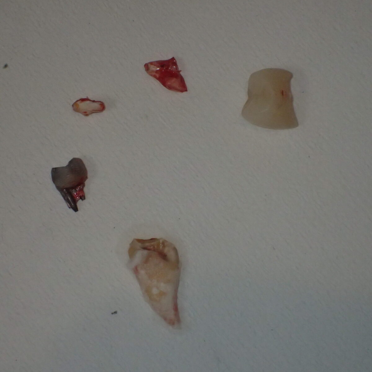 治療の方法が抜歯につながります