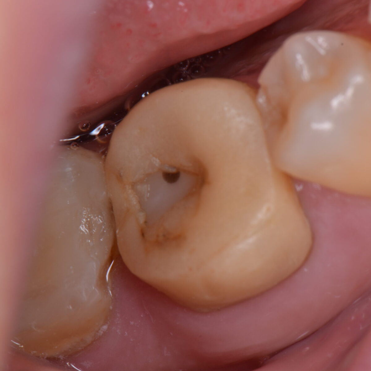 仮歯で長期間いるとどうなるの？？？