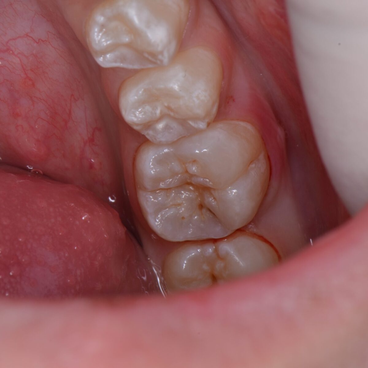 削らない治療はいい治療？