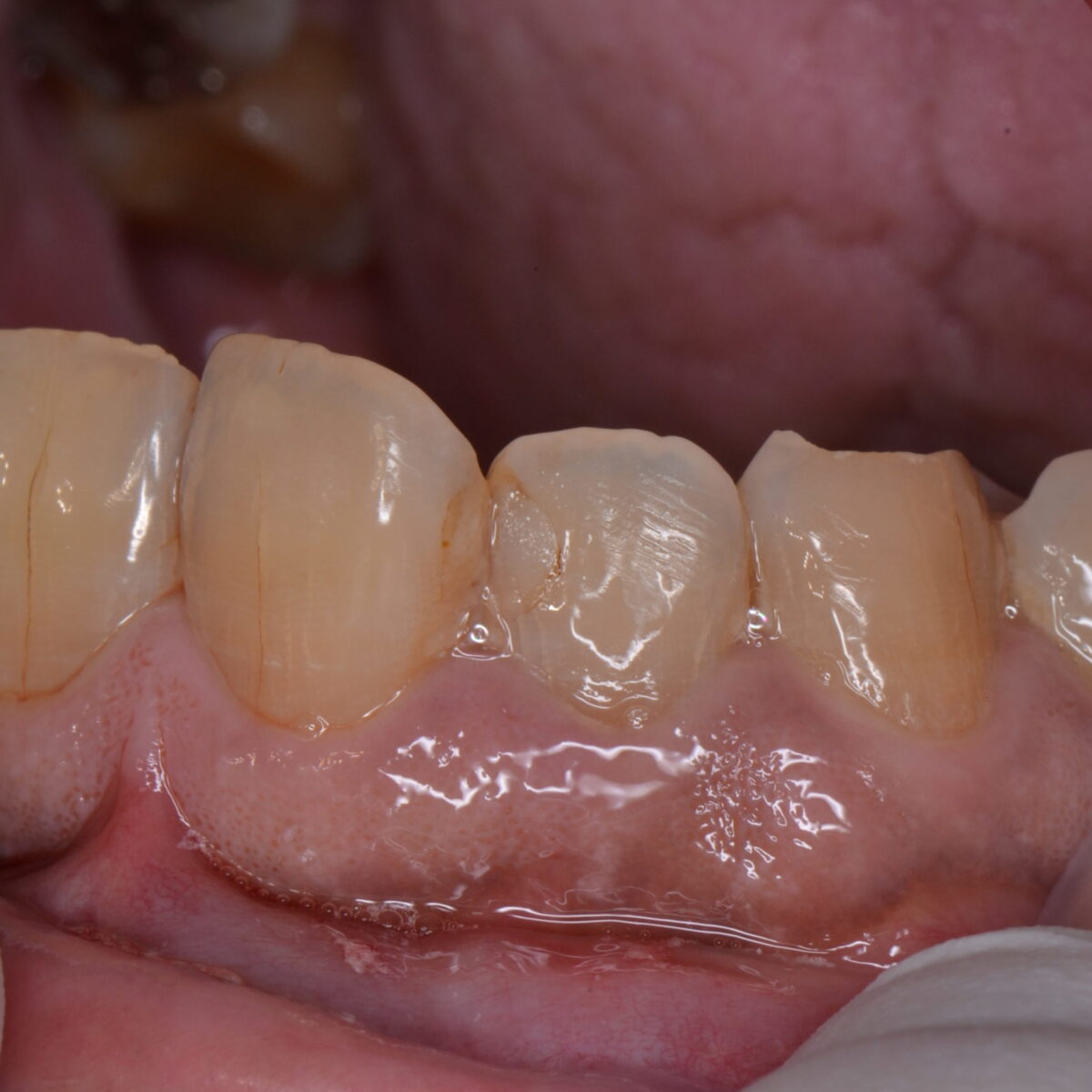 その白い詰め物、どのくらいもつと思いますか？