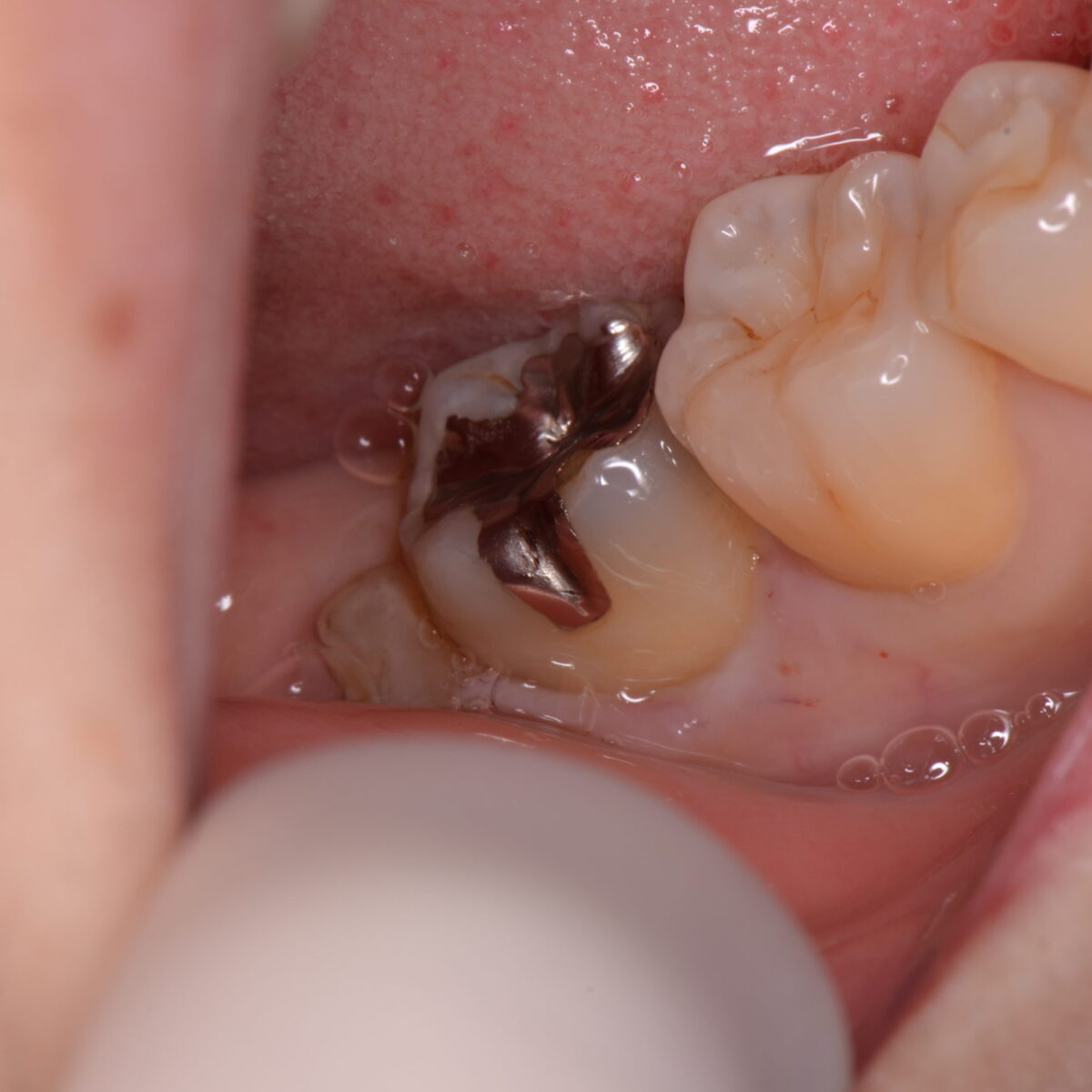 銀歯の下には・・・