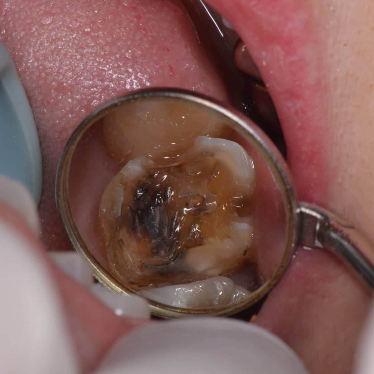 銀歯の下には・・・3