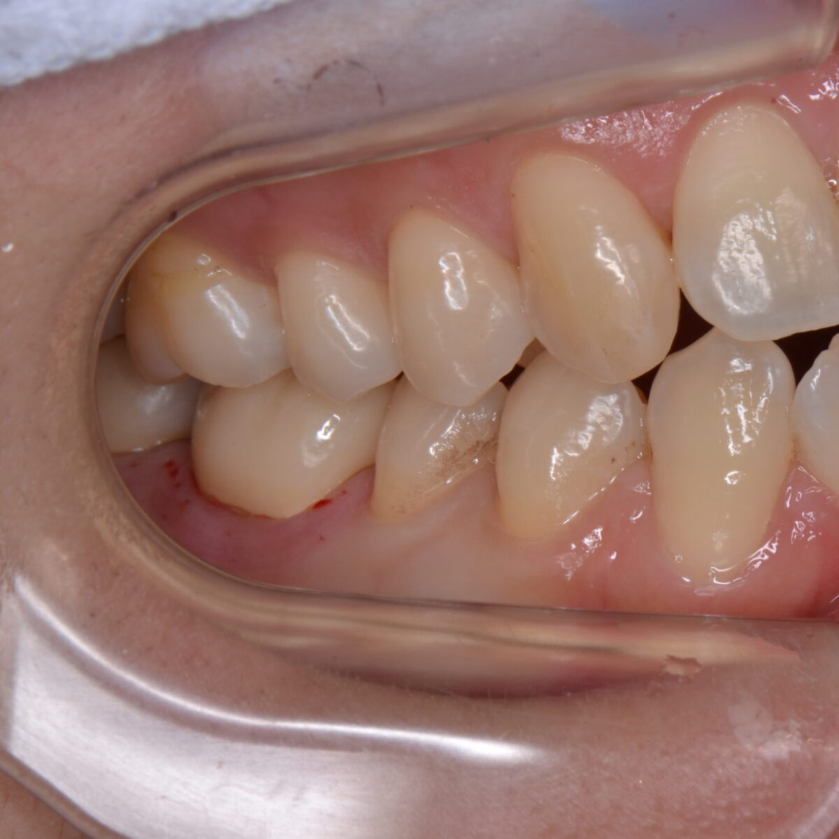 オールセラミックスクラウン