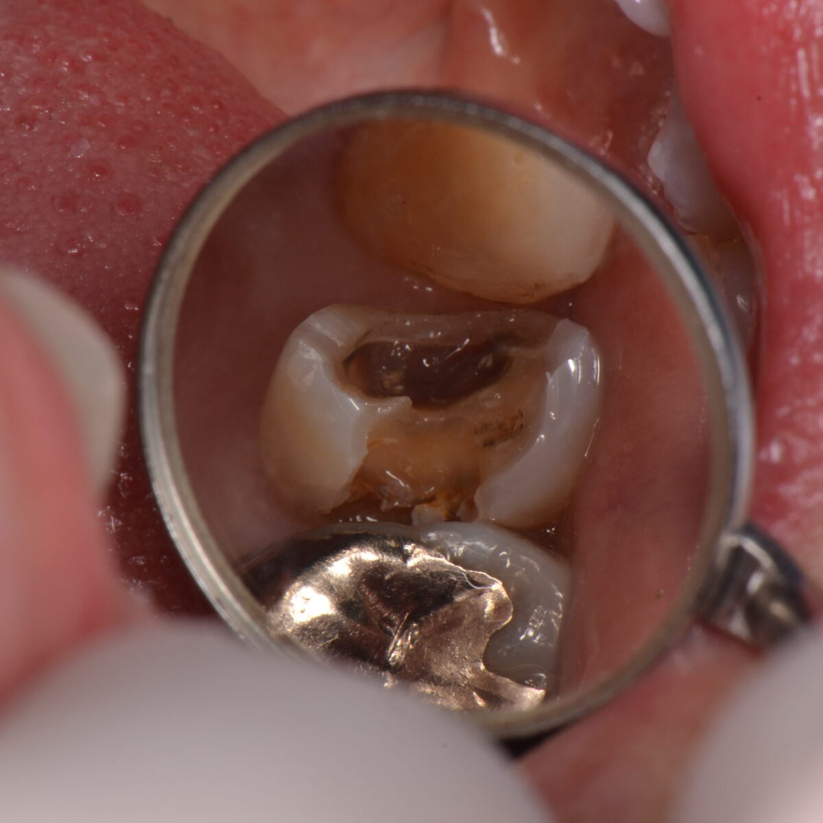 銀歯の下には・・・2