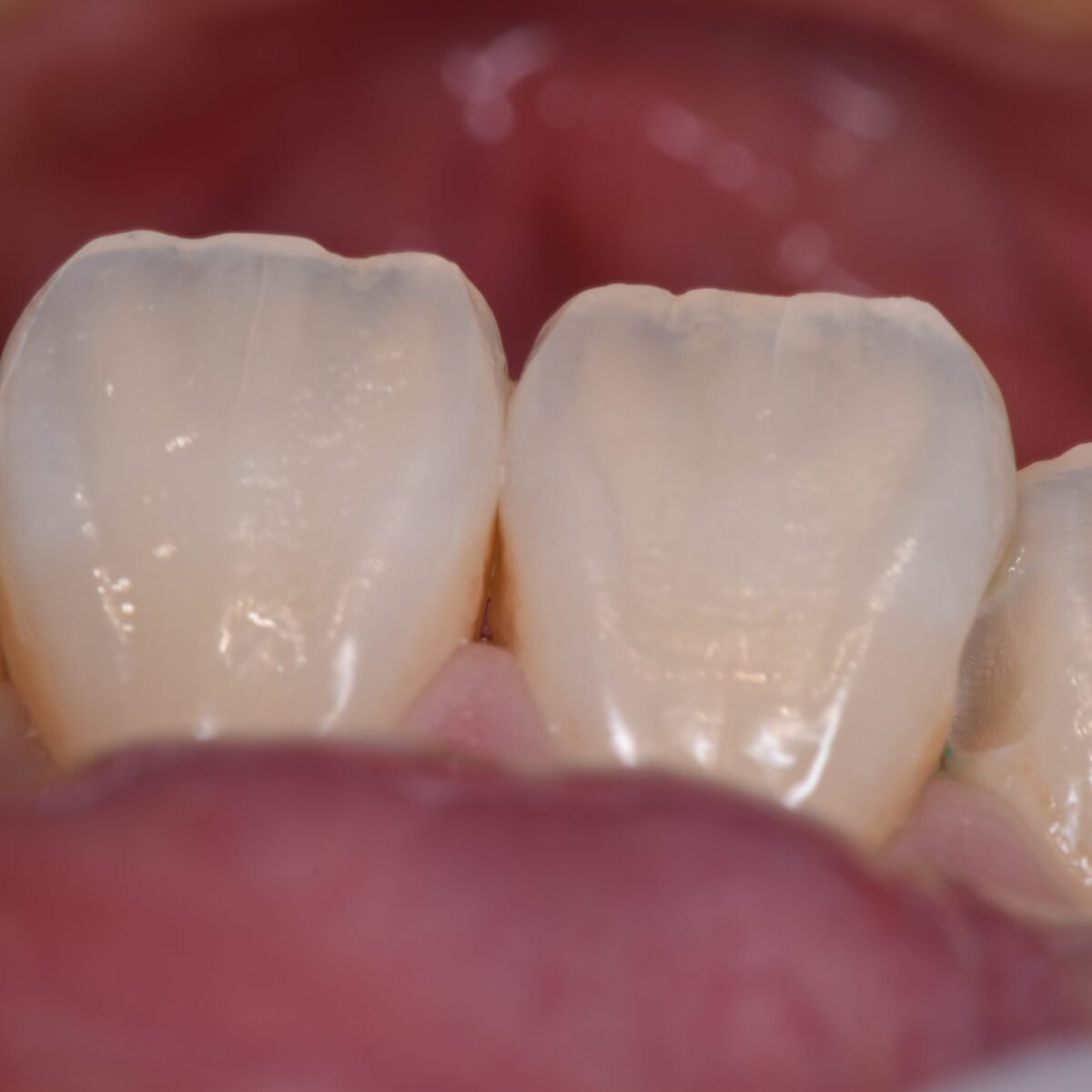 前歯のつめもの６