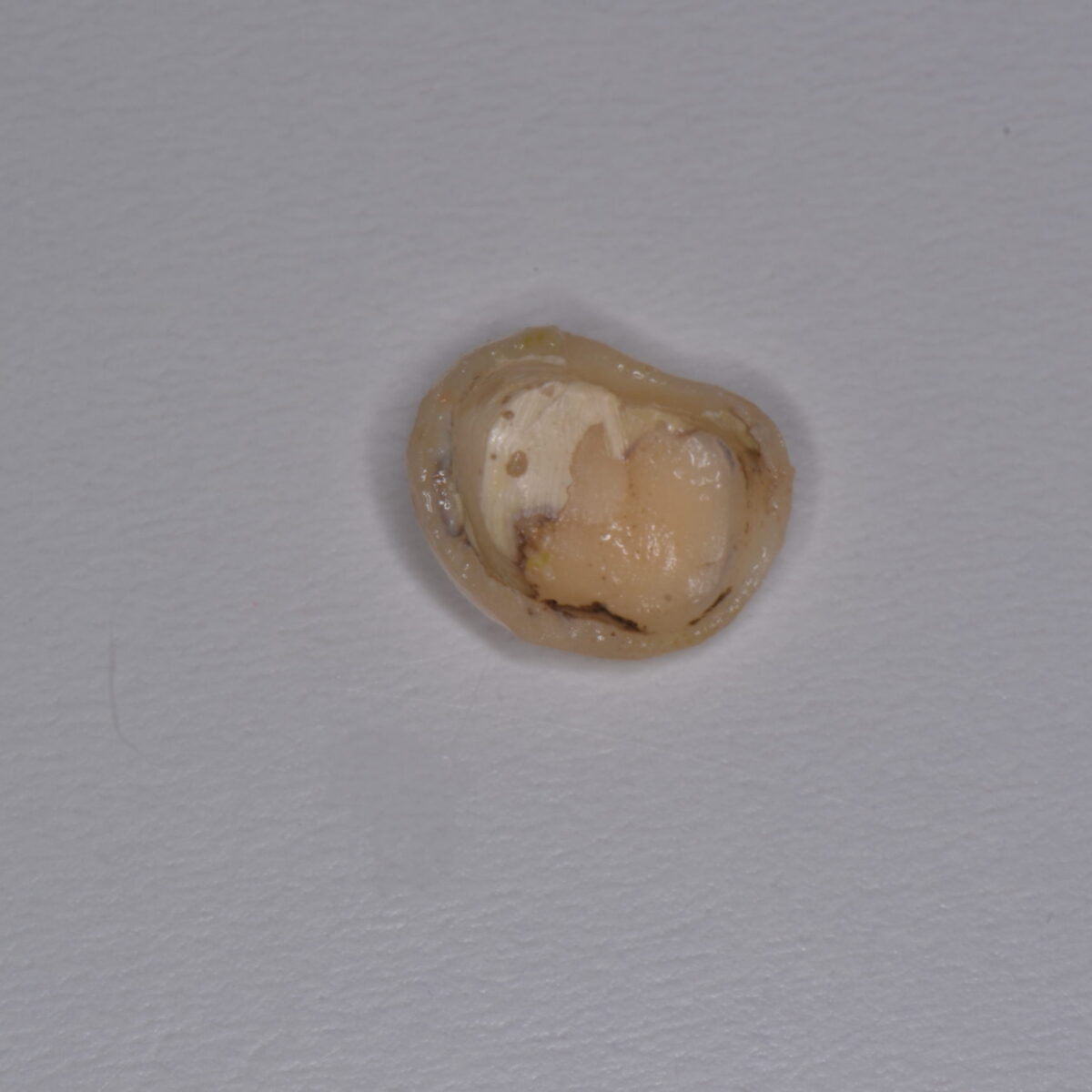 仮歯で時間が経つと・・・