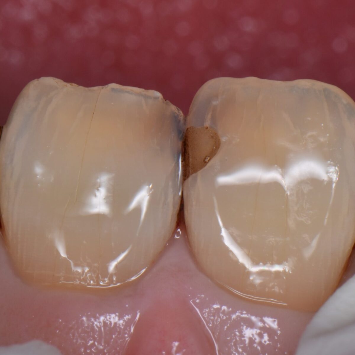 前歯のつめもの７