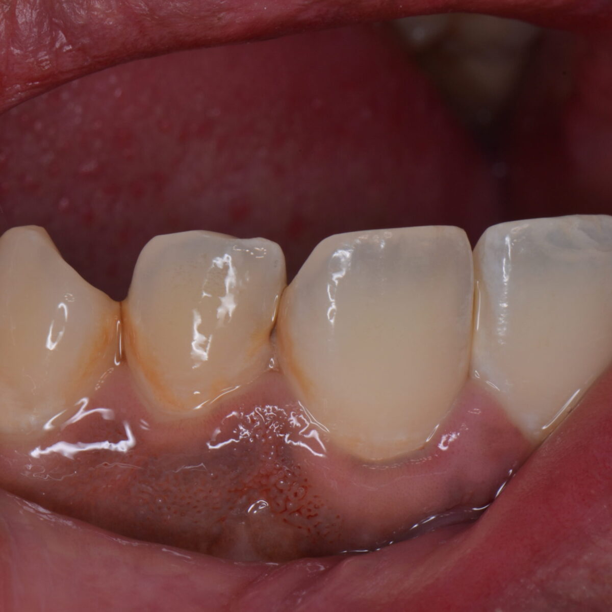 前歯のつめもの９