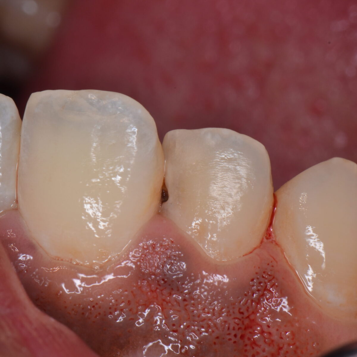 前歯のつめもの８