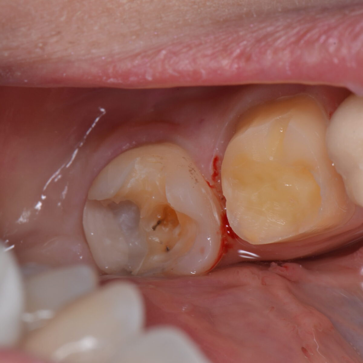 白いつめものの下