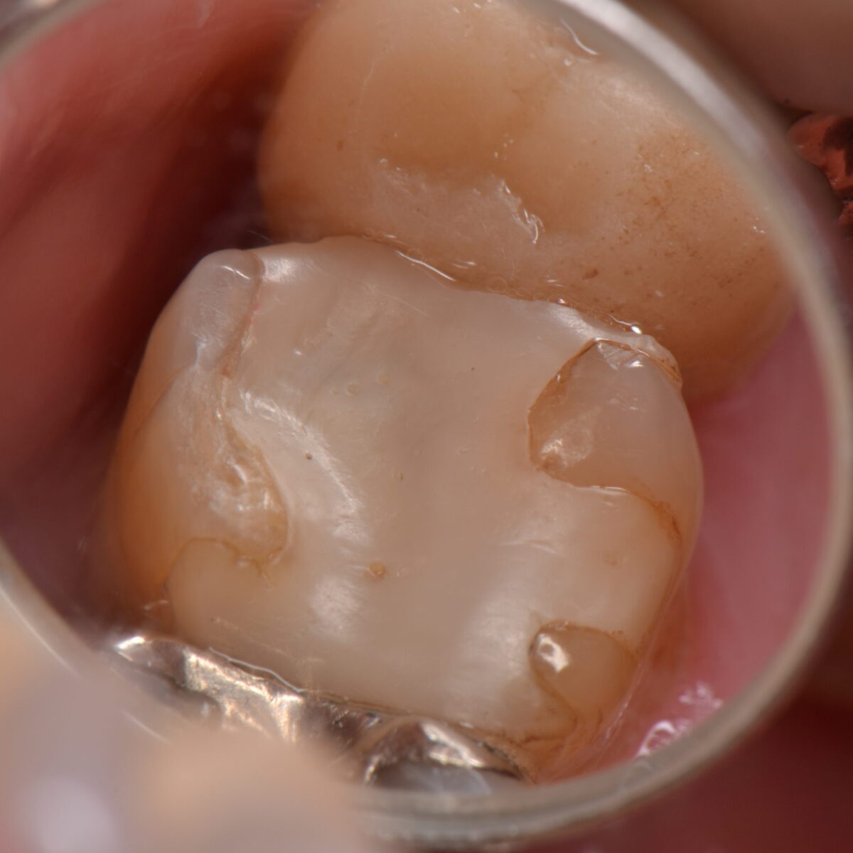 白いつめものの下３