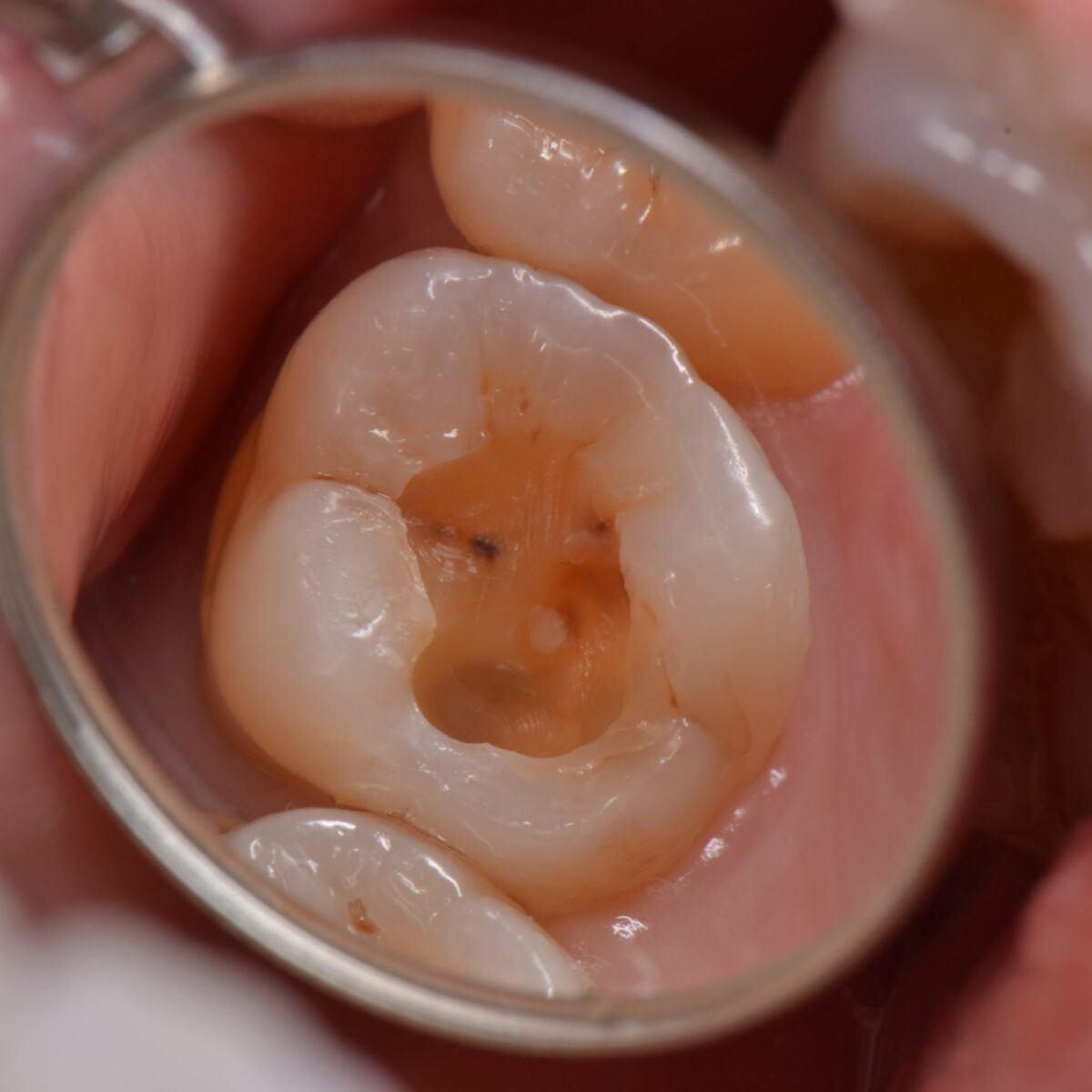 白いつめものの下２