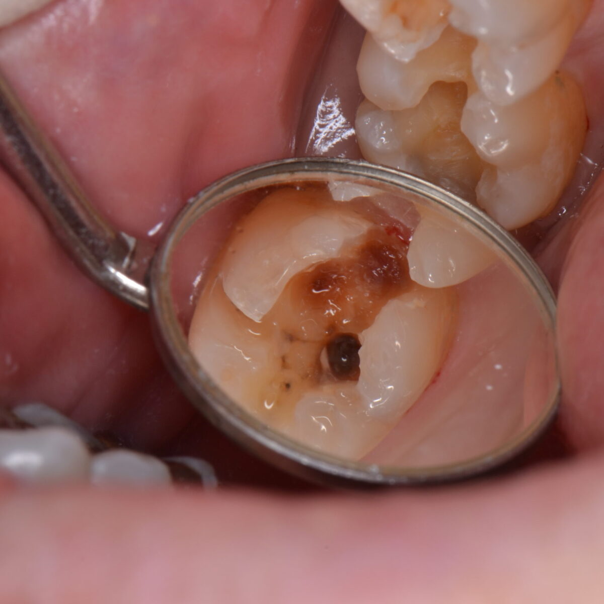 白いつめものの下４