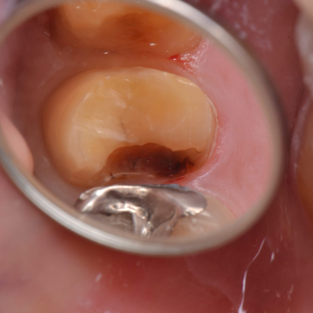 銀歯の下には・・・4