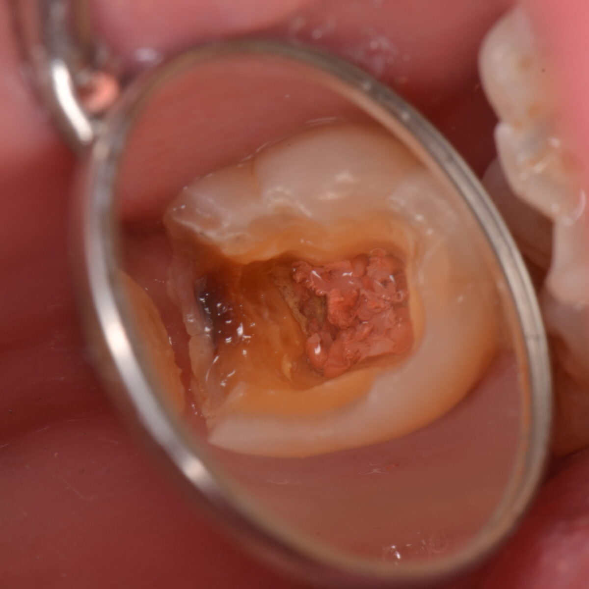 銀歯の下、２０年