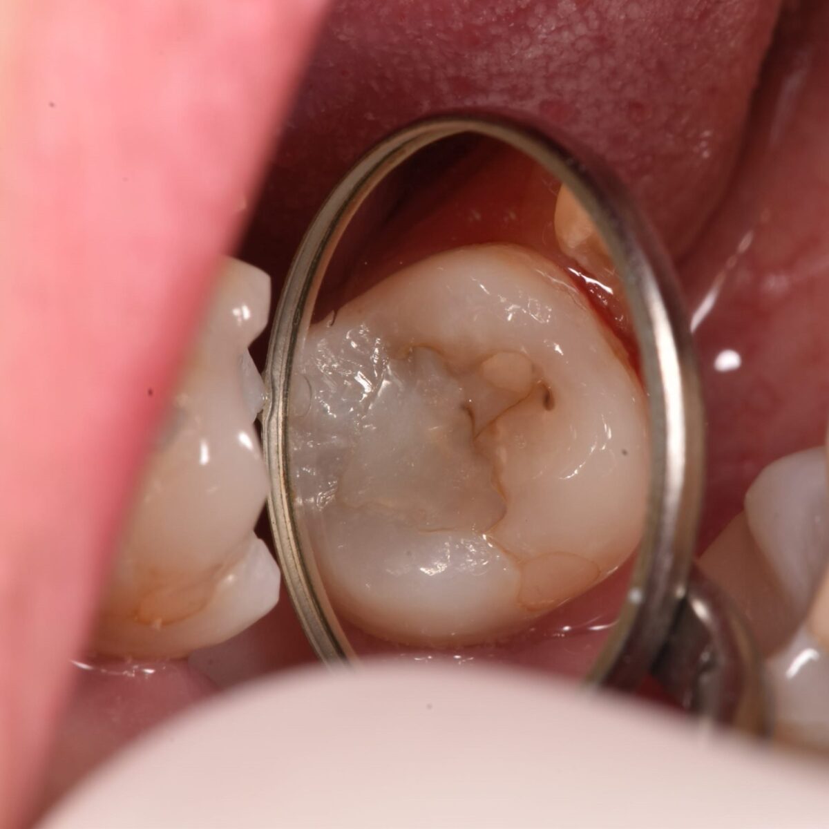 白いつめものの下５