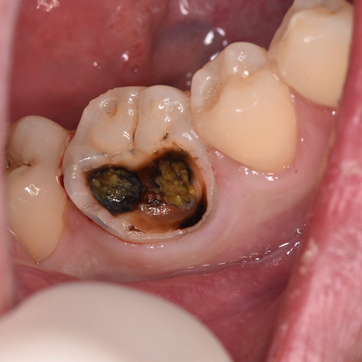 神経に近い虫歯の治療