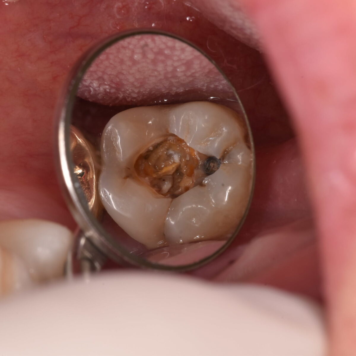 神経に近い虫歯の治療2