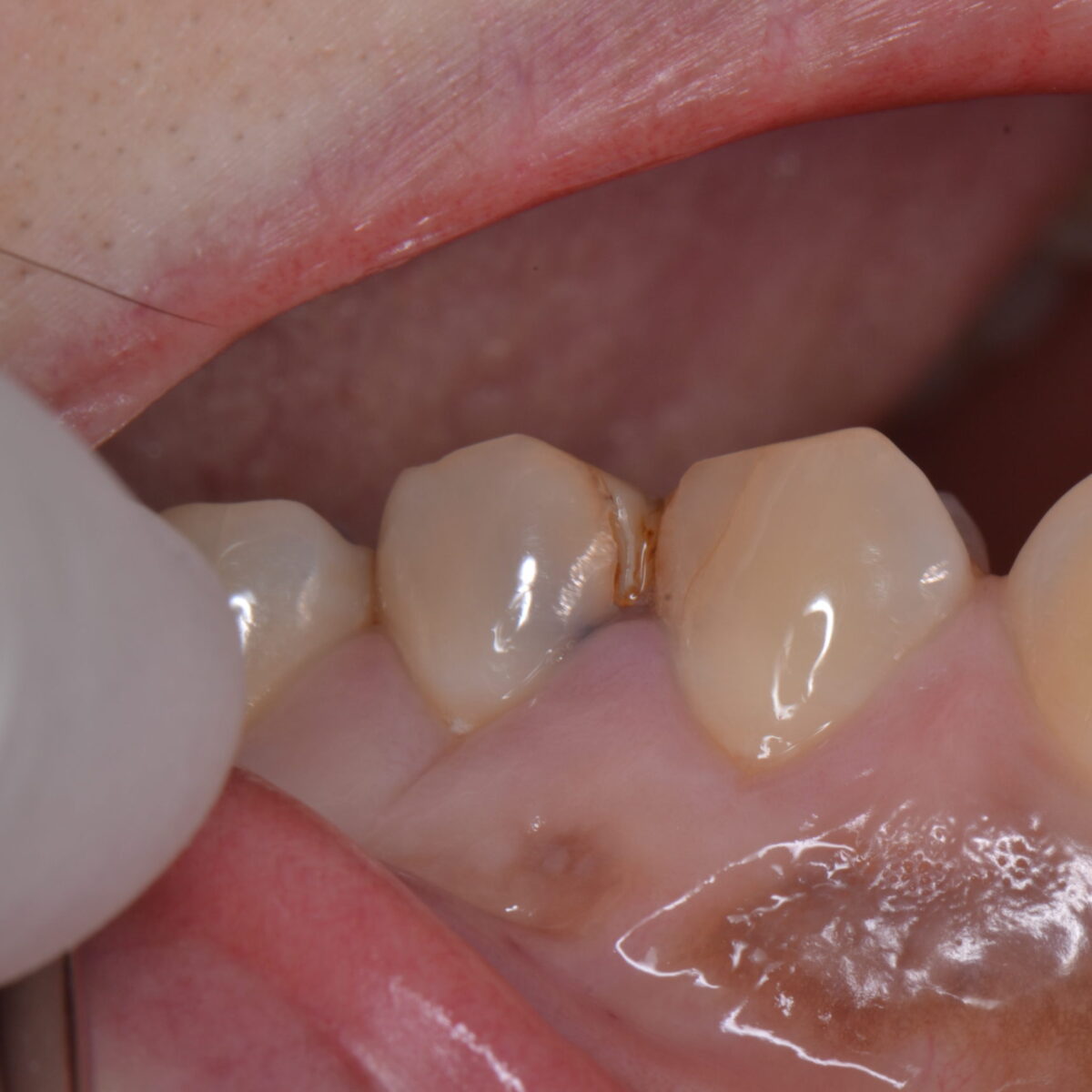 白いつめものの下６