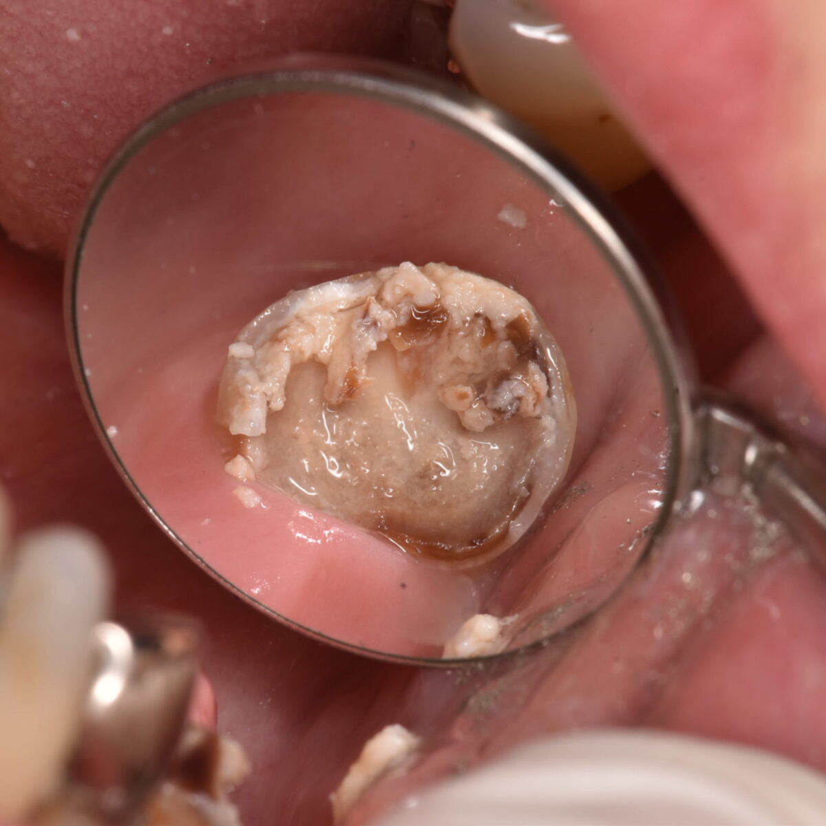 銀歯の下には・・・5(歯を抜くか、残すか?)