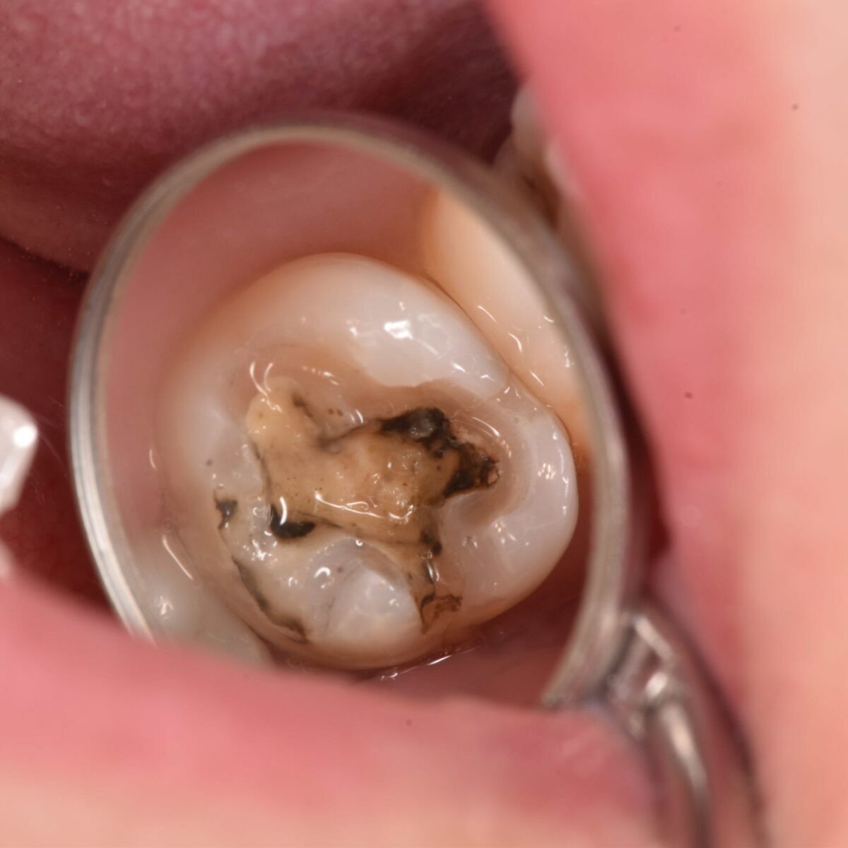 銀歯の下には・・・6