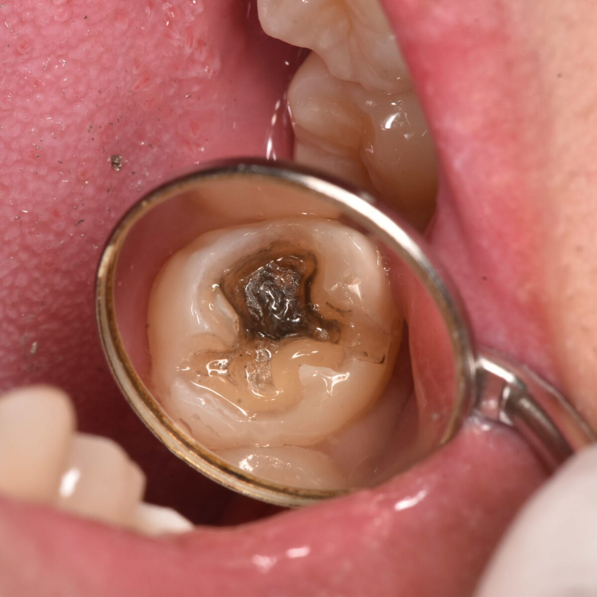 銀歯の下には・・・7