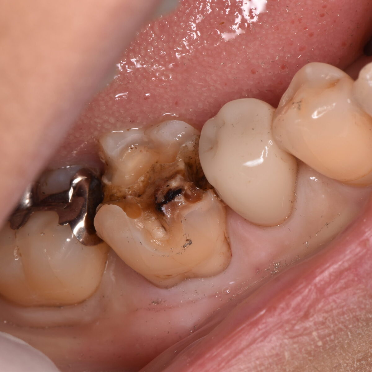 銀歯の下には・・・8