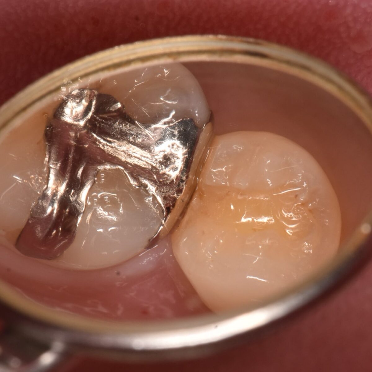 銀歯の治療は安全で長持ちするのか?