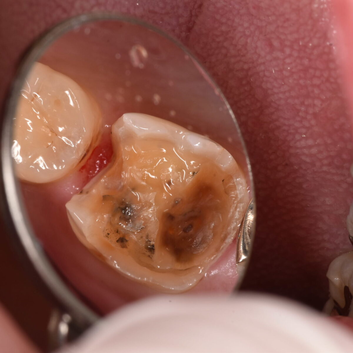 銀歯の下には・・・9