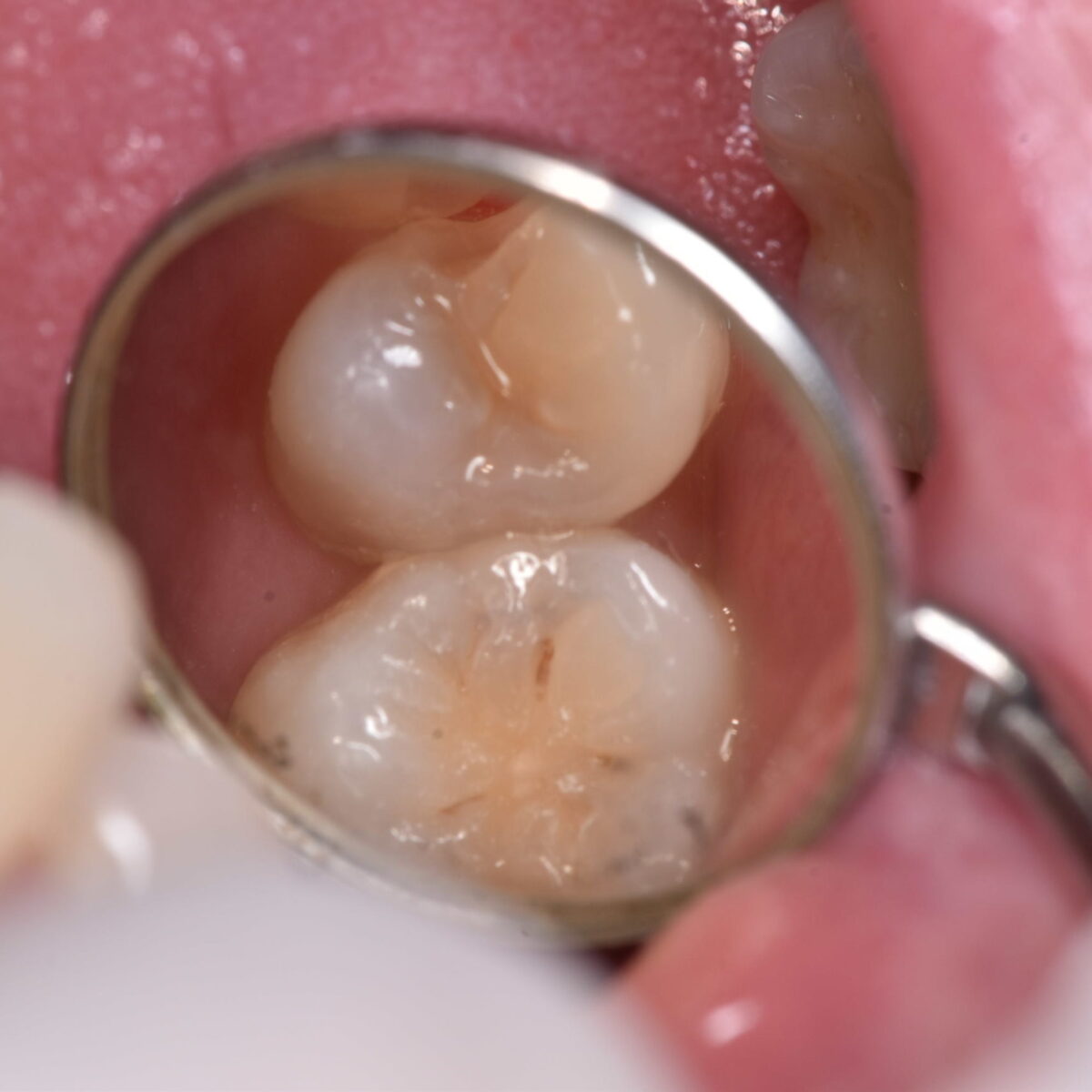 痛みがなければ虫歯じゃないの？