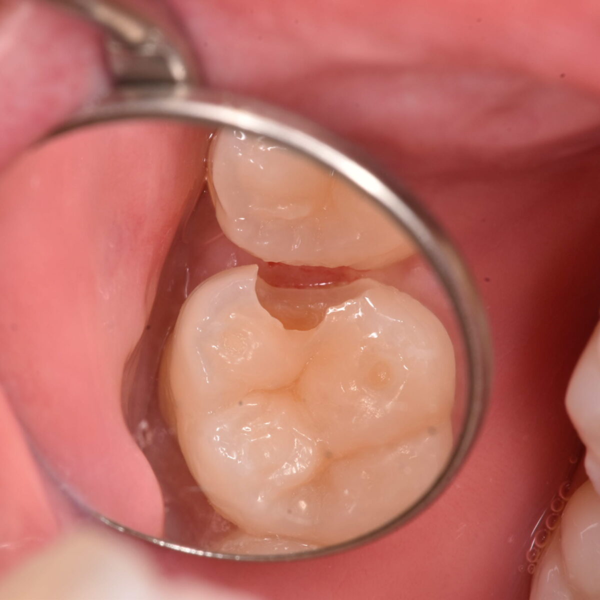 痛みがなければ虫歯じゃないの？２