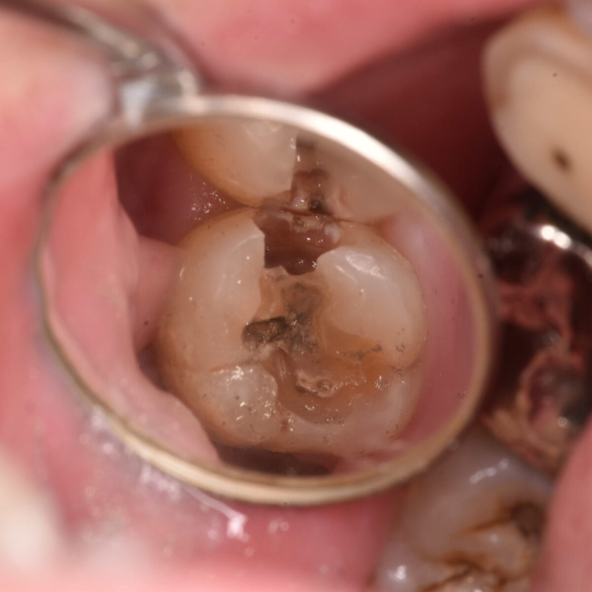 銀歯の下には・・・１１