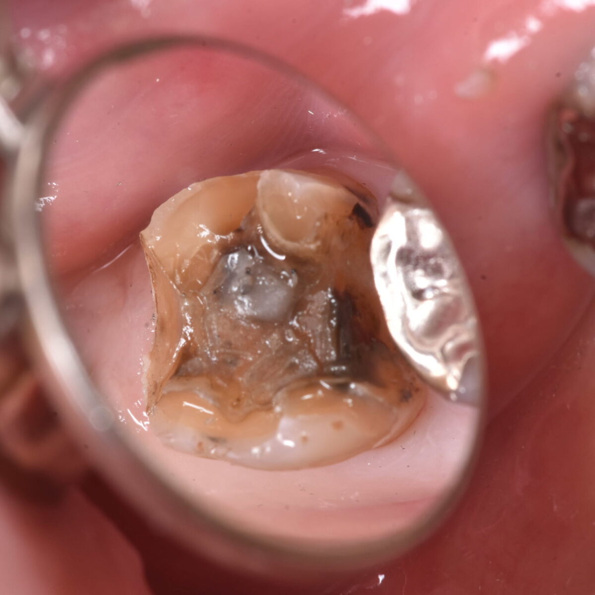 銀歯の中の問題は症状からはわからない