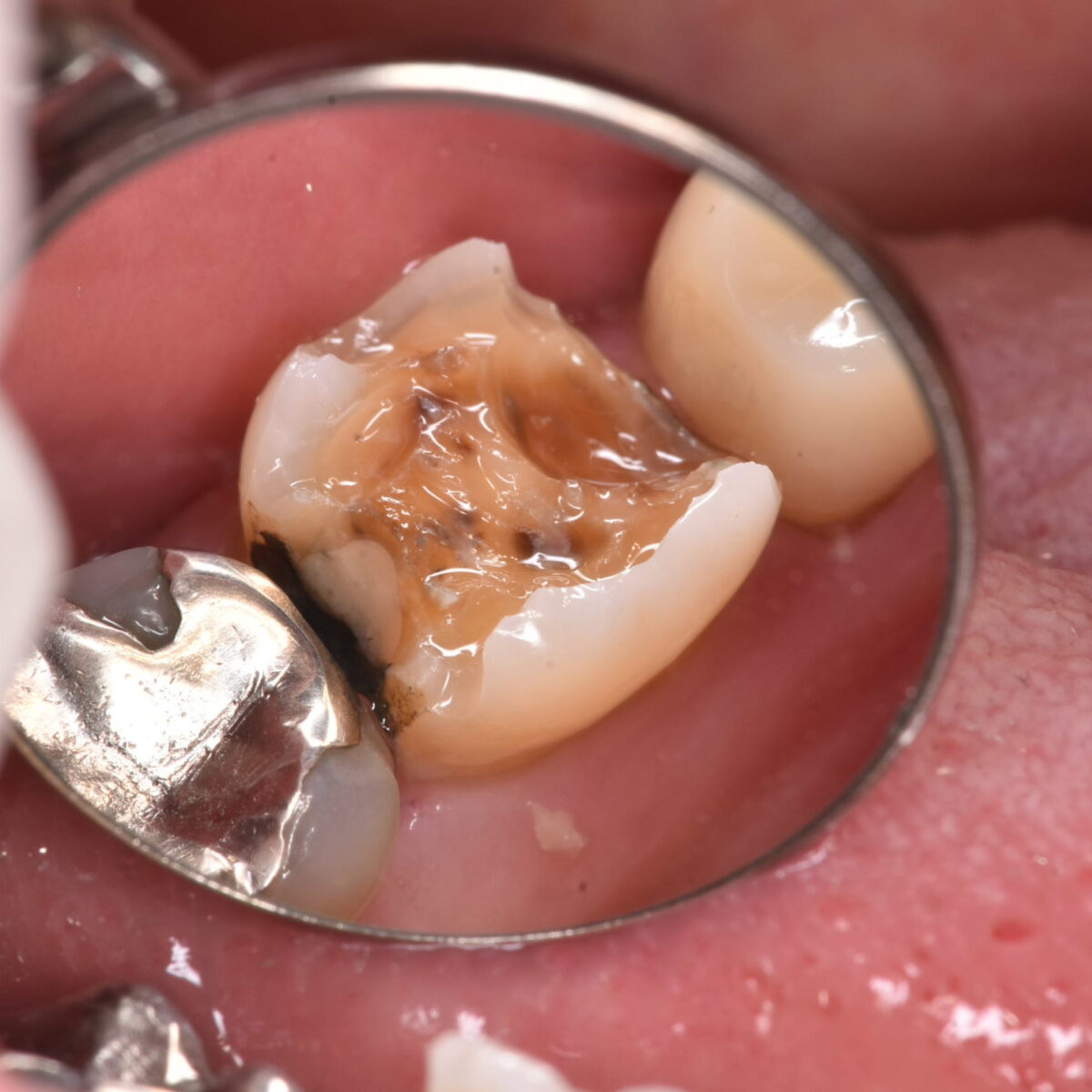 銀歯の中の歯の状態はどうなっているのか