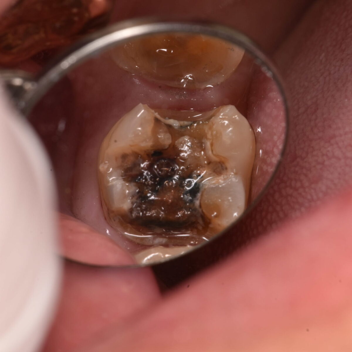 歯の治療をしたはずなのに・・・