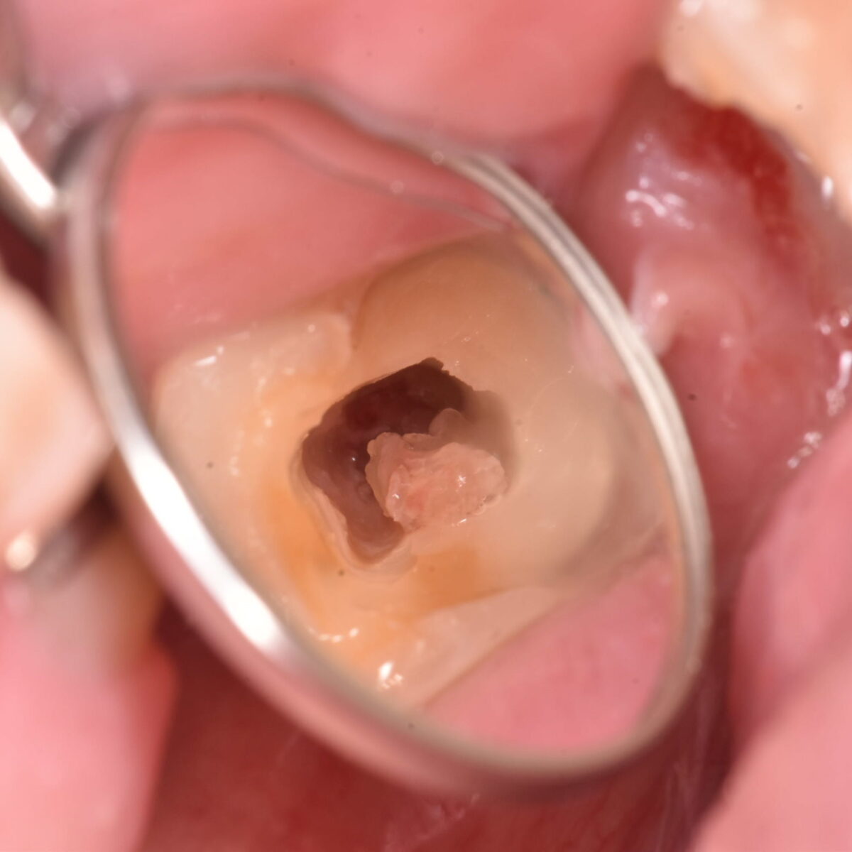 外から虫歯の大きさや深さはわかるのか？