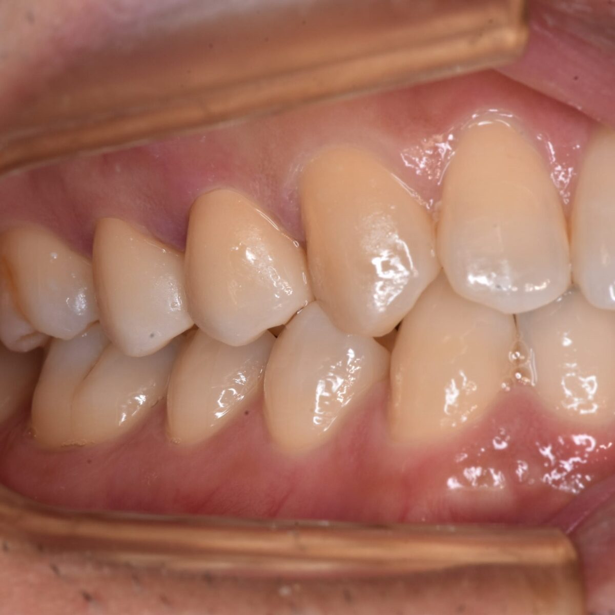 奥歯の神経に近いむし歯のセラミックス治療