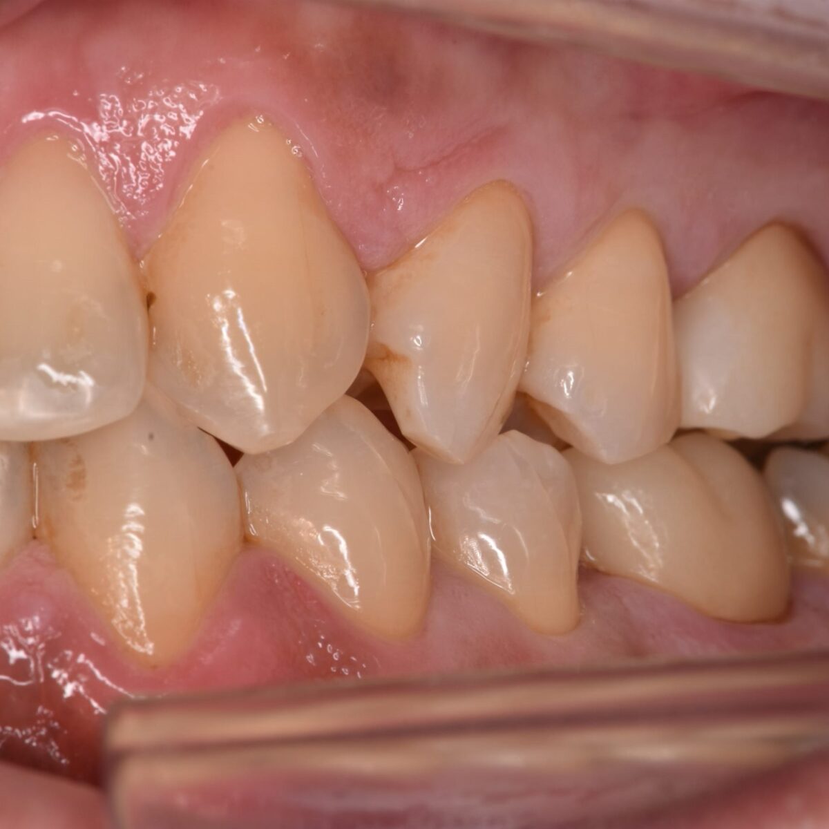 上下の奥歯を同時にセラミックスにした治療