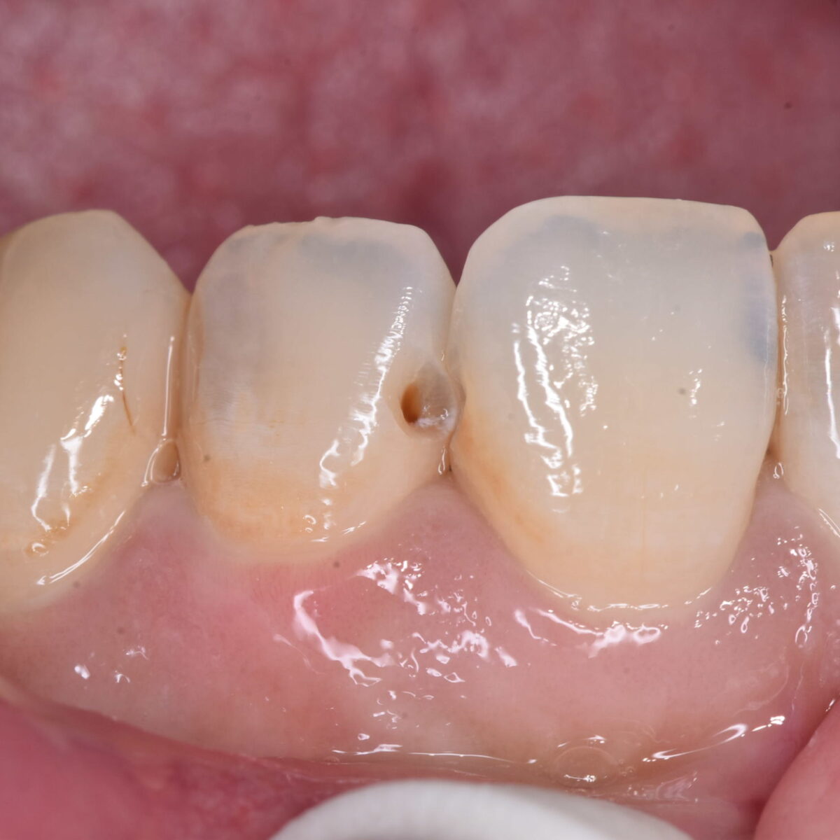 見た目が白くても、むし歯があることはある