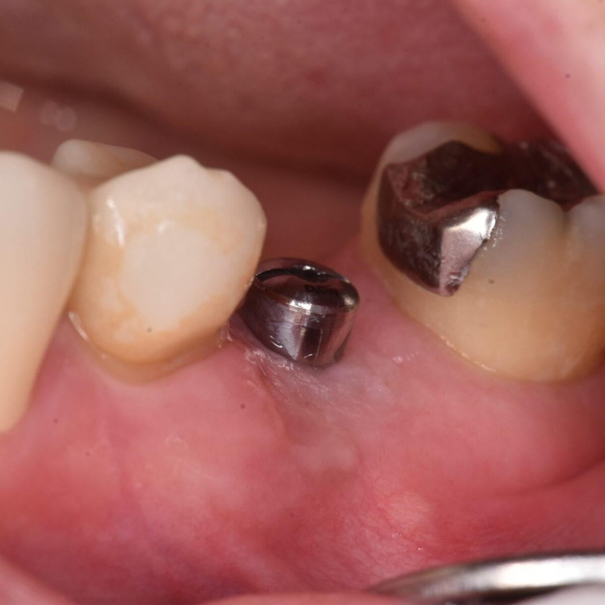 右上の奥歯の状態が悪くなり、抜歯してインプラントにしたケース