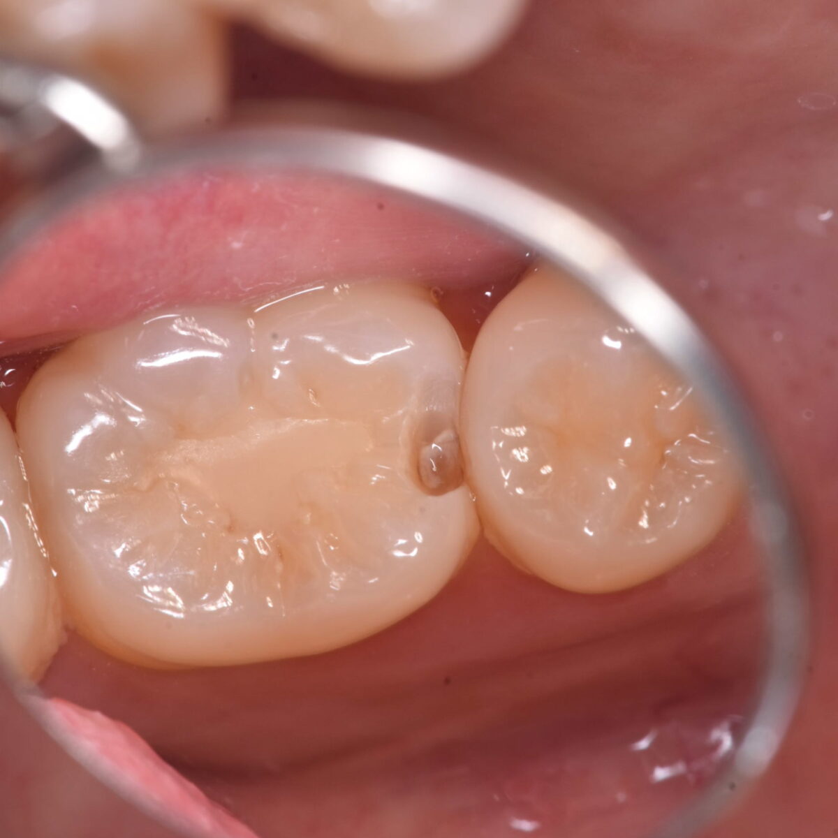 見た目が白く、何ともなさそうな歯でも・・・