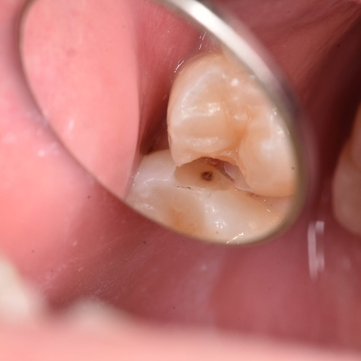 穴もない白い歯なのに問題があることがあるって本当？