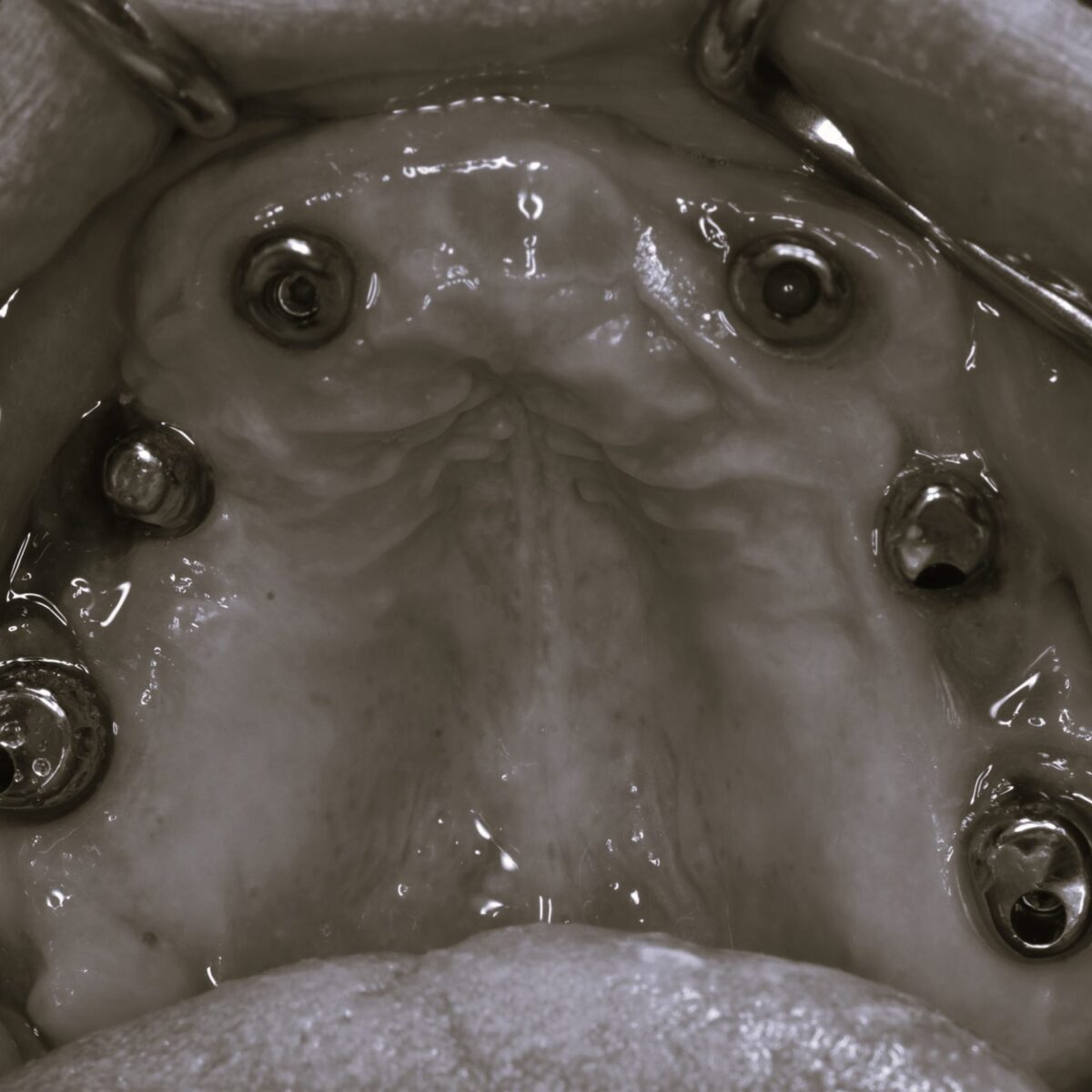 歯周病悪化で全ての歯を抜き、インプラントAGCブリッジとなったケース